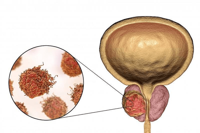 πώς φαίνεται η βλάβη του προστάτη;